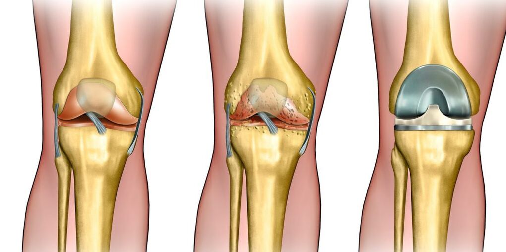 Arthrose van het kniegewricht