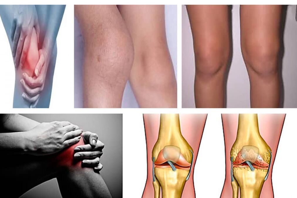 Symptomen van artrose van de knie